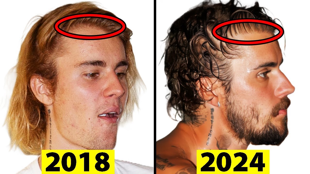 Justin Bieber’s New Hairline: Did He Go Under the Knife? Experts Weigh In